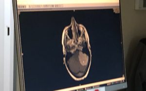 The white mass shows a nearly 6 centimeter brain tumor.